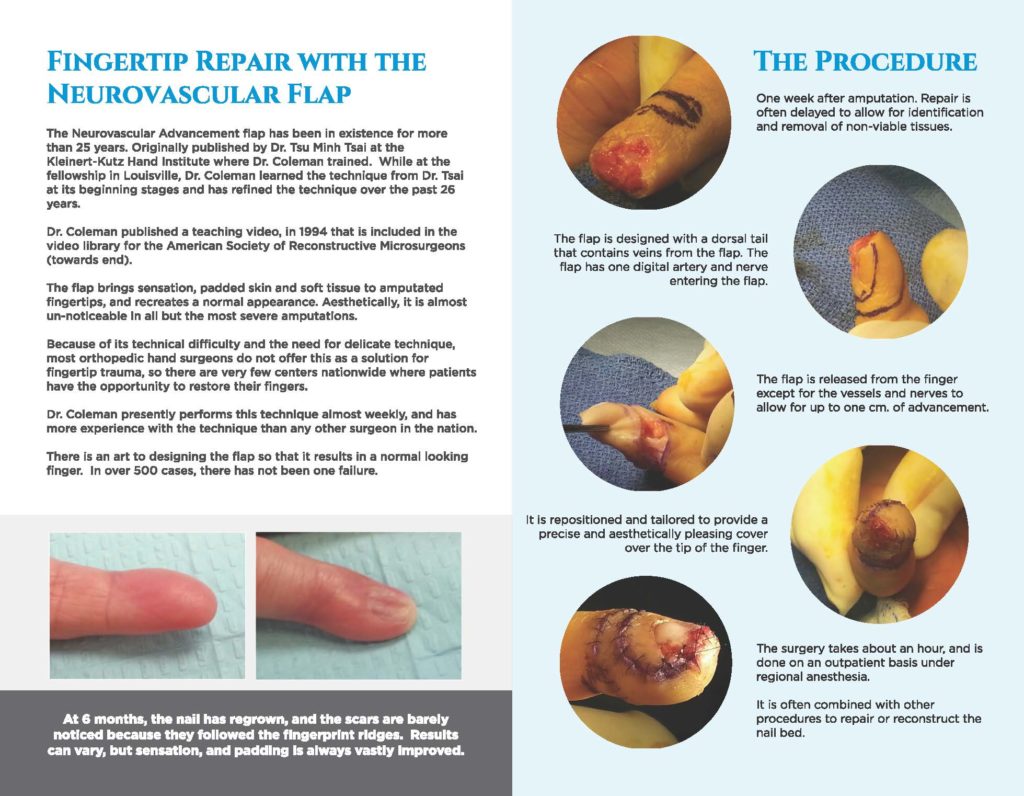 Fingertip Repair with the Neurovascular Flap Pg.2