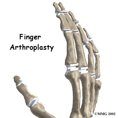 artificial joint replacement of the finger the hand thumb